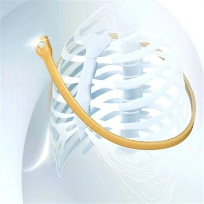 PEEK Sternal Fixation Belt